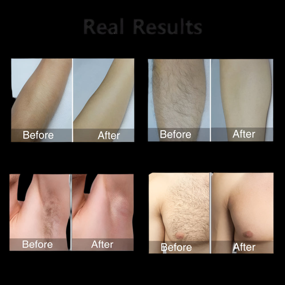 Before and after results of a hair removal treatment on various body parts.